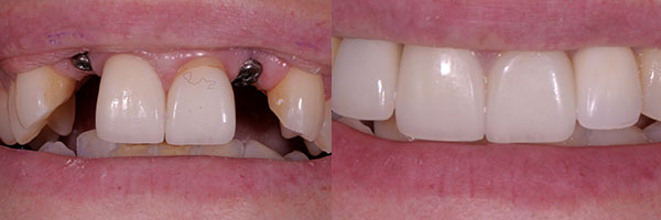 dental implant case