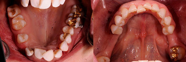 teeth examination before