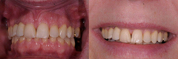 teeth implants after